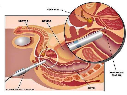 Exame Biópsia da Próstata